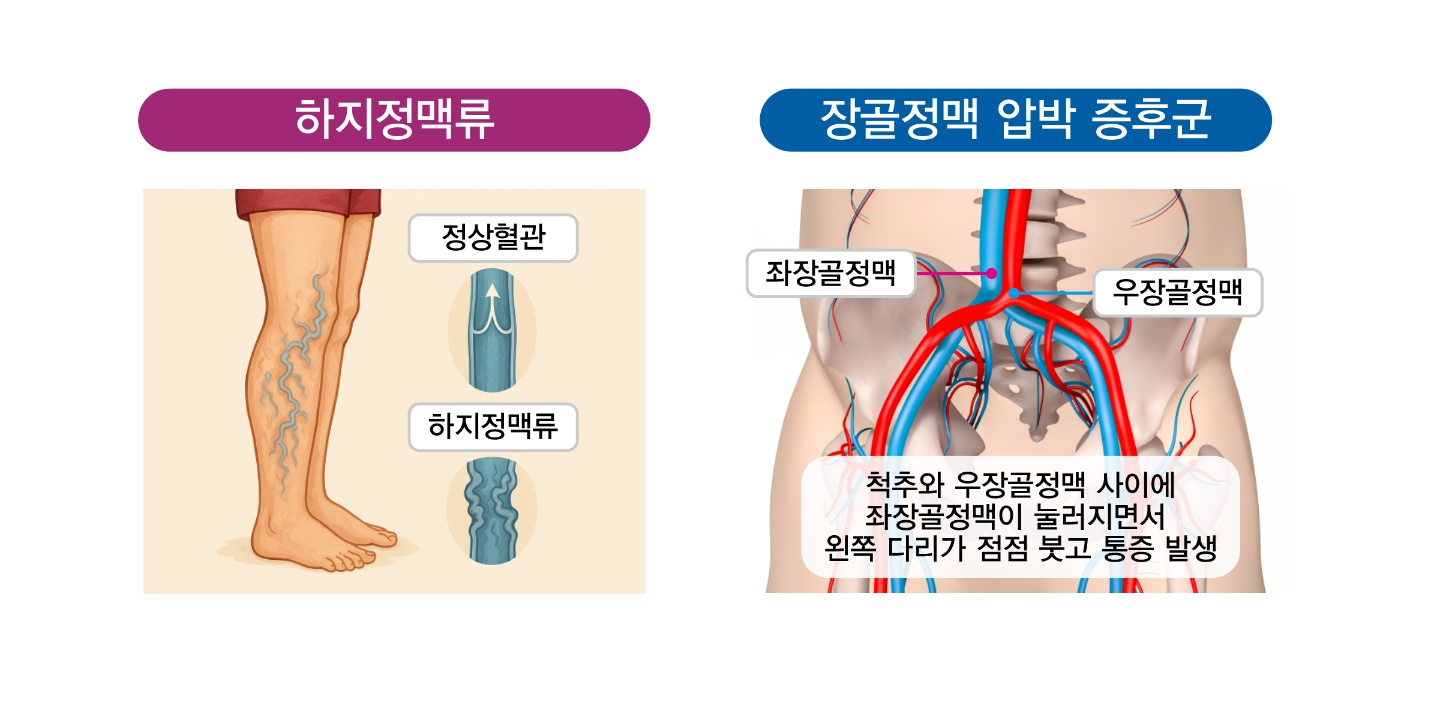 하지정맥류 장골정맥 압박증후군.png.jpg