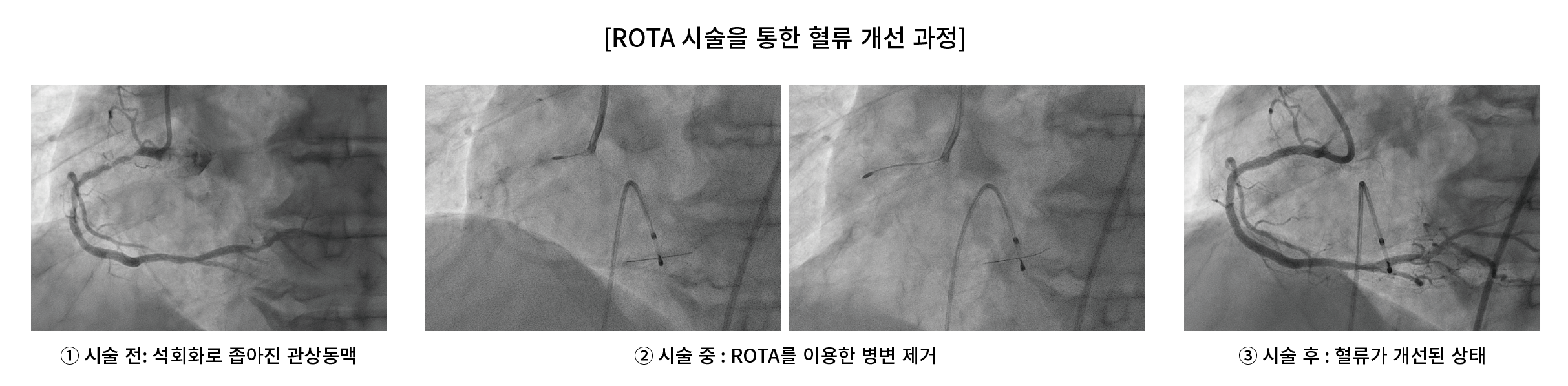 ROTA 시술을 통한 혈류 개선 과정 사진.png